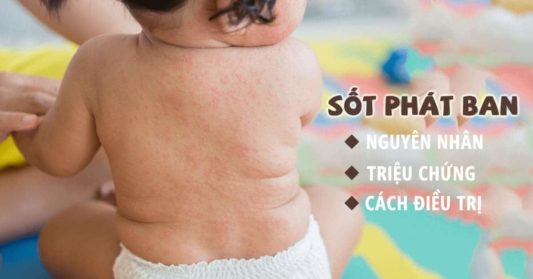 Sốt phát ban (ban đào) trẻ em