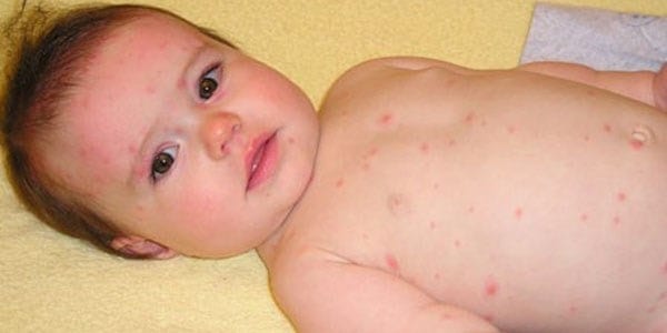 top 7 bệnh thường gặp ở trẻ vào mùa lạnh