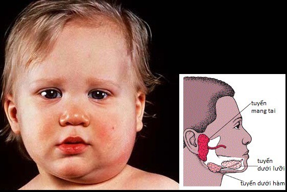 top 7 bệnh thường gặp ở trẻ vào mùa lạnh