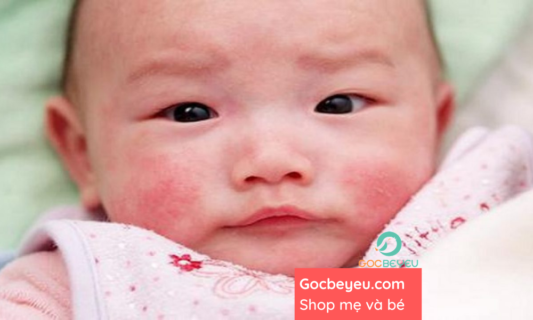 Những dấu hiệu nổi bật của nổi mề đay